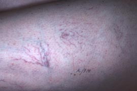 Veins on the thigh  - Before