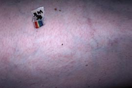 Veins on the thigh  - After