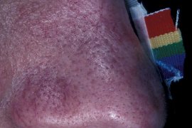 REDNESS AND DISTINCT BLOOD VESSELS - Before