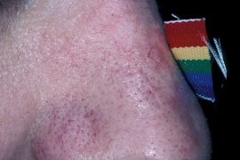 REDNESS AND DISTINCT BLOOD VESSELS - After