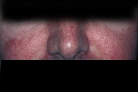 treatment for Rosacea using Ultimate Light - Before