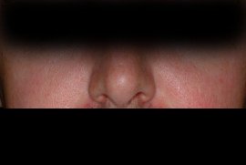 treatment for Rosacea using Ultimate Light - After