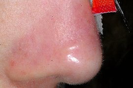 Right side of nose - After