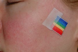 Decrease in baseline redness and flush - Before