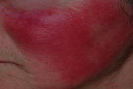 Facial Redness - Before