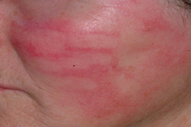 Facial Redness - After