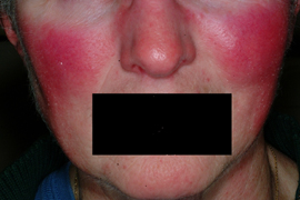Facial redness removal - Before