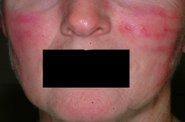 Facial redness removal - After