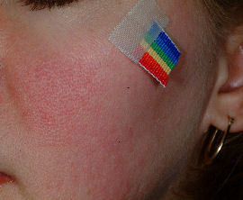 flushing of cheek - before