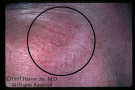 Rosacea on the cheek - Before