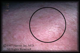 Rosacea on the cheek - After