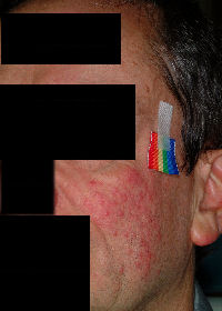 Left Cheek: 54 y/o male - Before