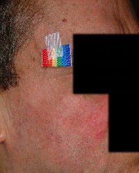 Rosacea's pimples and redness - After