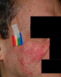 Rosacea's pimples and redness - Before