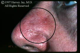 Surgical scar - Before