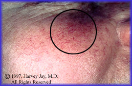 Blood vessels & rosacea - Before