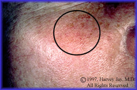 Blood vessels & rosacea - After