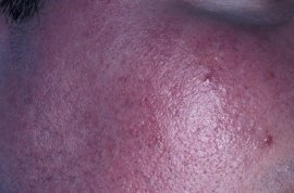 decreased frequency of flushing - Before