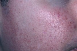 decreased frequency of flushing - After