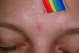 Angioma on forehead of male patient - Before