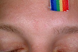 Angioma on forehead of male patient - After