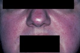 FLUSHING CLEARED - Before