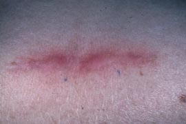 Elevated pink surgical scar - Before