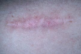 Elevated pink surgical scar - After