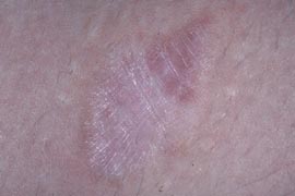 scar - Right inner thigh - After