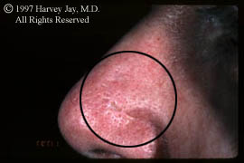 Treatment of Rhinophyma - After