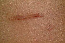 dark scar lightened - Before