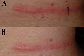 hypertrophic scar/keloid on neck - Before