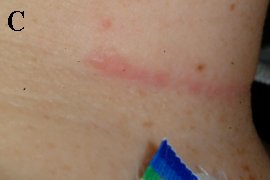 hypertrophic scar/keloid on neck - After