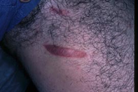 Stretch Marks - Before