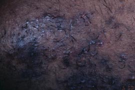 Successful Hair removal laser treatment - Before