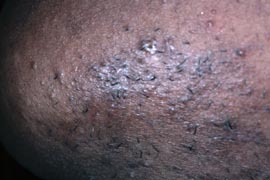 Successful Hair removal laser treatment -  After