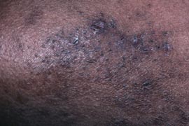 EpiLight treatment -  After