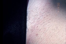 Bikini of 30 yr old female - Before