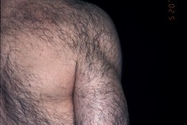 35 year old male SHOULDER - Before