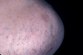 Right side of chin - Before