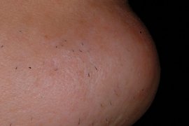 Right side of chin - After