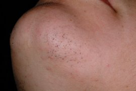 Chin of 25 year old female - Before