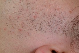 Left sideburn of 25 year old female - Before