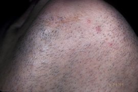 Chin of a female - Before