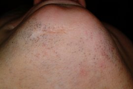 Chin of a female - After