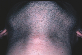Male Facial Hair Removal - Before