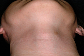 Male Facial Hair Removal - After