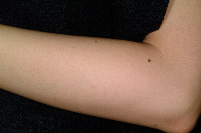 Left forearm of a 30 yr old female - After