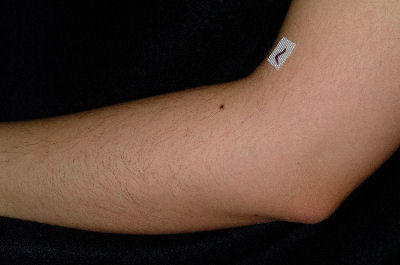 Left forearm of a 30 yr old female - Before